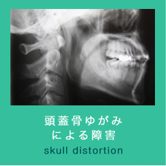 頭蓋骨ゆがみによる障害